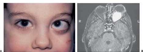 Optic Nerve Tumors | Ento Key