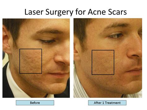 The Best Lasers to Treat Acne Scars, Fractional CO2 Laser, Fraxel