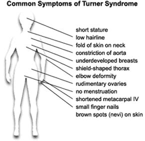 Symptoms & Characteristics - Turner Syndrome