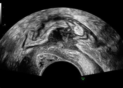 3D Ultrasound Endometriosis | Empowered Women's Health