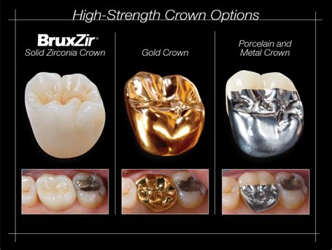 Should you get an all ceramic or gold crown? - JoyFulTeeth!