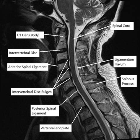 Mri Cervical Spine Lumbar Spine Mri Scan Images Spinal Stenosis | Images and Photos finder