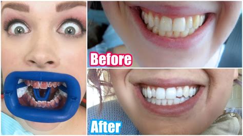 Laser Teeth Whitening Before And After Pictures - TeethWalls