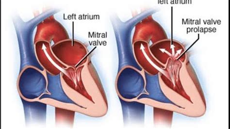 What Is Mitral Valve Regurgitation - Symptoms, Causes, And ...