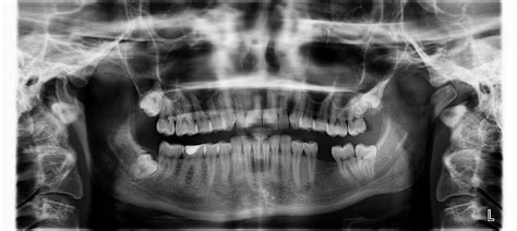 OPG X Ray: Understanding the Procedure & Guidelines