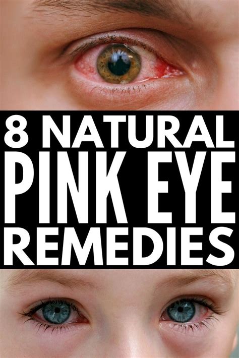 Pin by cameronkb3jl0 on Health | Natural pink eye remedy, Pinkeye ...