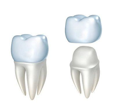 Dental Crown Replacement | Emergency Dental Service