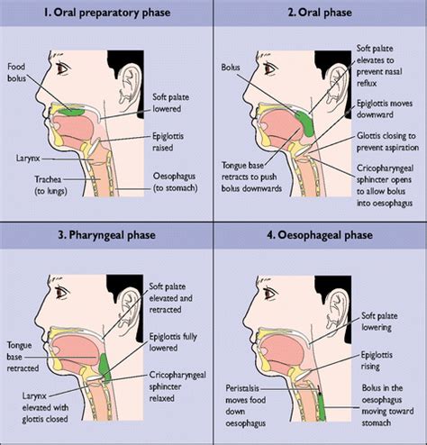 Dysphagia Stroke