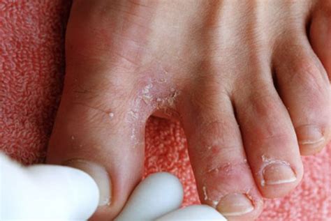 👉 Foot Fungus - Pictures, Types, Causes, Symptoms, Treatment (January 2022)