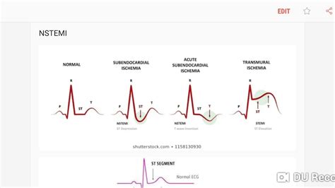 Nstemi Ecg Examples