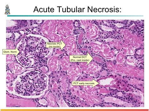 Pathology of Glomerulonephritis