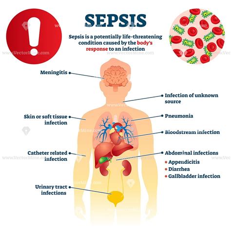 Sepsis Infection - Edelhard Verlin