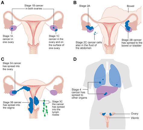 √ Stomach Stage 1 Ovarian Cancer Bloating Pictures - Cancers Free Full Text Kinase Inhibitors ...