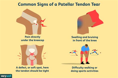 Patellar Tendon Tear: Symptoms, Causes, and Treatment