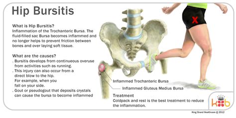 Hip Joint Bursitis Tendinitis Causes Signs Symptoms Diagnosis | The Best Porn Website