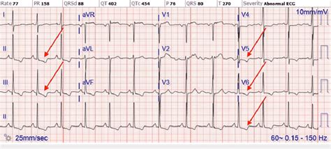 ECG of initial NSTEMI showing T wave inversion in leads II, III, aVF,... | Download Scientific ...