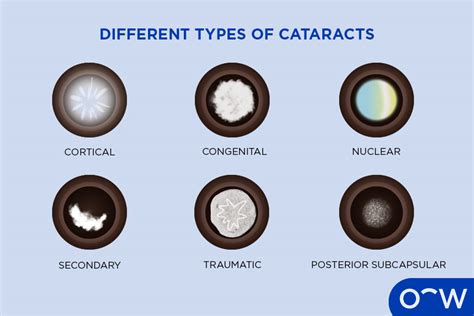 Cataracts: Definition, Types, Causes, Symptoms, Treatment, and Prevention