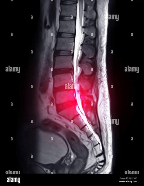 MRI L-S spine or lambar spine sagittal T2 technique for diagnosis spinal cord compression Stock ...