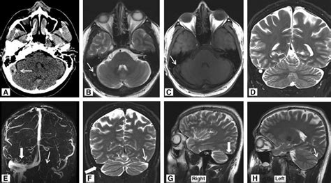 Images of a 37-year-old male patient admitted with headache. (A)... | Download Scientific Diagram