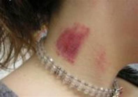 How to Get Rid of a Hickey in Less Than 4 Steps | PairedLife