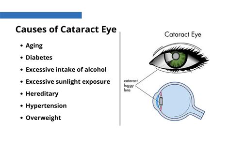 Cataract Eyes Are at Kendra Flowers blog