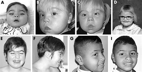 Chromosome Deletion Disorders