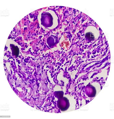 Biopsi Tumor Tulang Belakang Meningioma Psammomatosa Tubuh Psammoma Foto Stok - Unduh Gambar ...