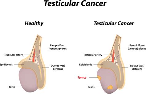 Testicular Cancer Lump