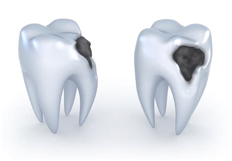 Cavities and Tooth Decay | Dr. Nechupadam Dental Clinic