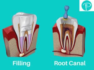 Cavity Filling vs. Root Canal - Two Main Difference - Dental Pickup