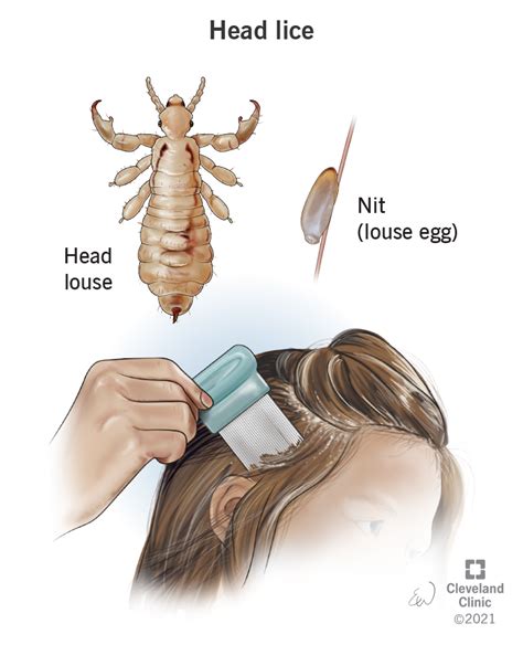 Understanding How Lice Treatment Works On Head Lice | Lice Nits