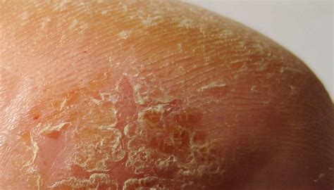 Scaling skin: Pictures, causes, treatment, and prevention