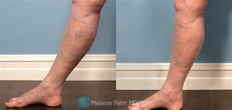 Sclerotherapy Before and After -Spider Veins -Varicose Veins