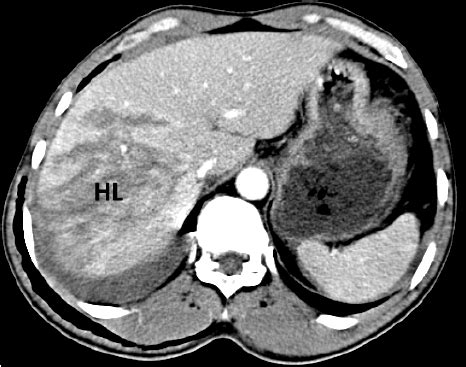 Abdominal CT. Degree IV liver laceration. | Download Scientific Diagram