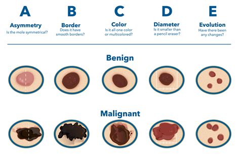 Skin Cancer & Carcinoma Treatment | WNY Dermatology