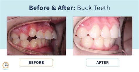 Braces: Before and After Buck Teeth