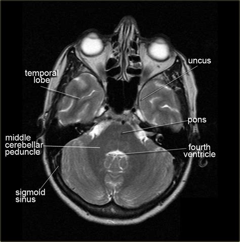 Mri Brain Anatomy Radiology