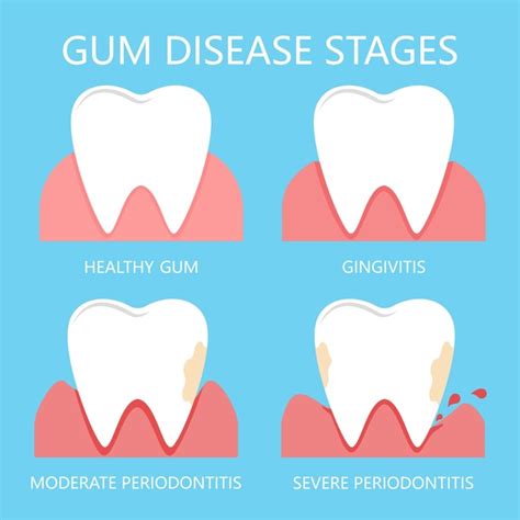 Periodontal Disease Stages