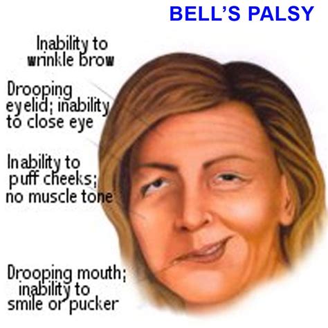 Cranial Nerve Palsy Symptoms