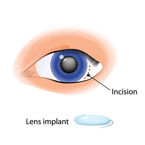 Cataract surgery - Kersley Eye Clinic London