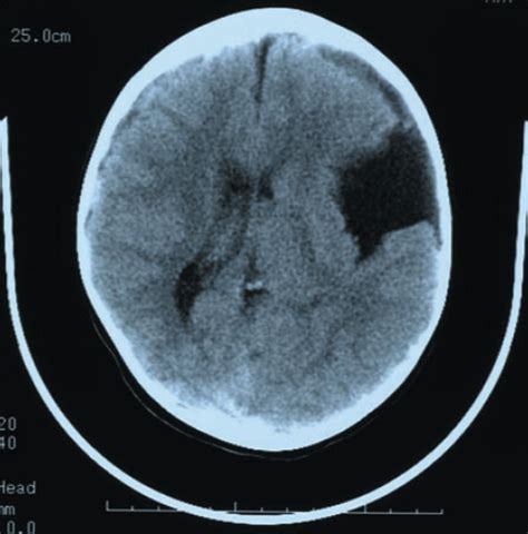 Arachnoid Cyst | Consultant360