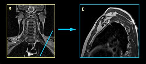 MRI BLOG: Brachial Plexus MRI (I/II)