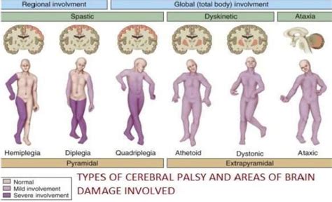 TYPES OF CEREBRAL PLASY | Download Scientific Diagram