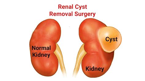 Kidney Cyst: Symptoms, Causes, Diagnosis & Treatment