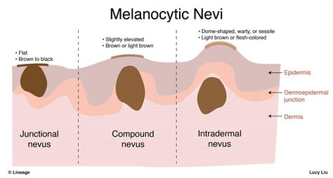 Nevus - Dermatology - Medbullets Step 1