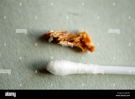 Large piece of Ear wax removed from child with blocked hearing Stock Photo: 29156129 - Alamy