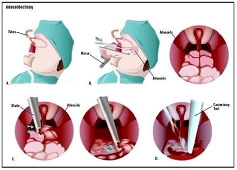 Adenoid Problems – The Risks Involved With Adenoidectomy