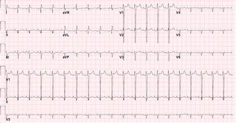 Classic ECG findings in dextrocardia include right or extreme axis ...