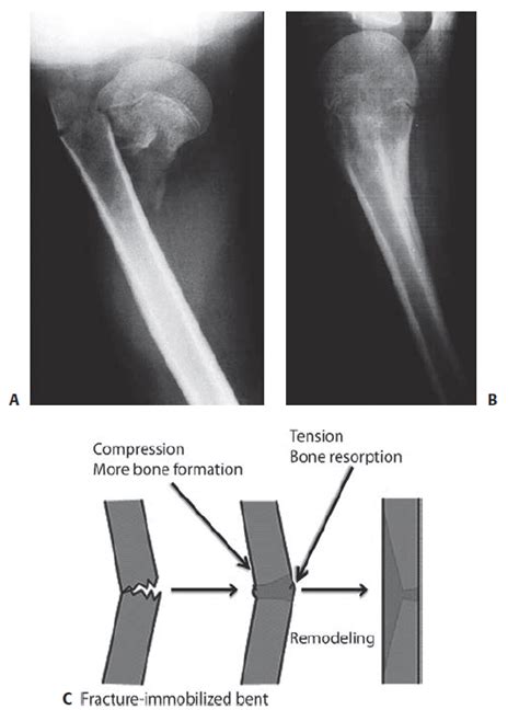 General Principles - Pediatric Fracture Management | Epomedicine