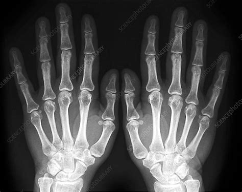 Healthy hand bones, X-ray - Stock Image C009/6744 - Science Photo Library